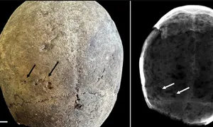 Phát hiện cocaine trong mô não ướp xác thế kỷ 17